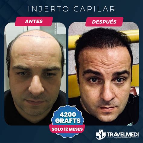 Injerto Capilar Travelmedi