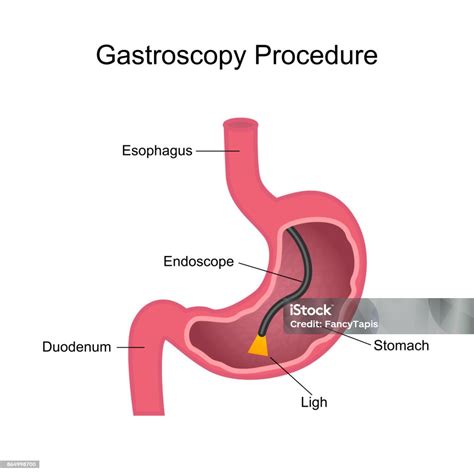 Gastroscopy Procedure Diagram Stock Illustration Download Image Now Endoscope Abdomen