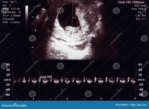 Ultrasound Scan 10 Weeks Heartbeat Stock Image - Image: 6182961