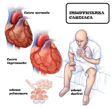 Insufficienza Cardiaca Scompenso Cardiaco FertilityCenter