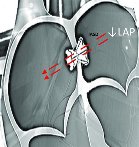 Interatrial Shunt Device IASD With Blood Flowing Red Arrows From