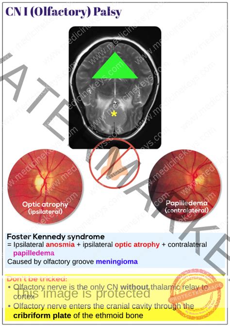 Cn I Olfactory Palsy Medicine Keys For Mrcps