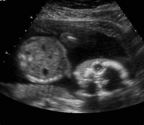 Normal 13 week baby ultrasound. - Ultrasoundfeminsider