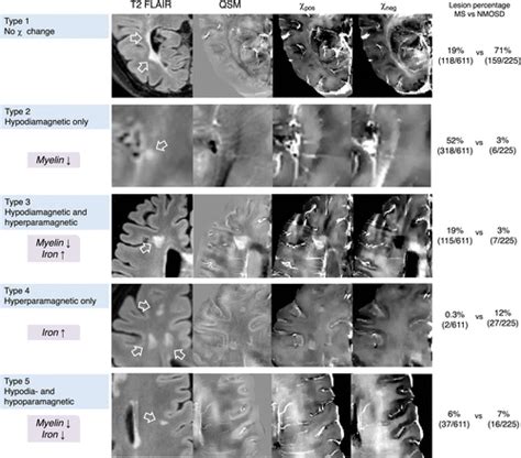 χ Separation Imaging For Diagnosis Of Multiple Sclerosis Versus Neuromyelitis Optica Spectrum