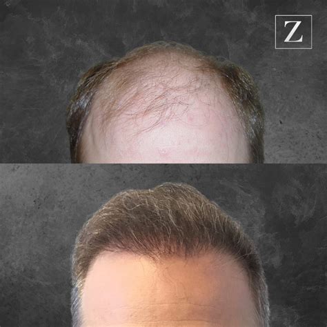 Fut Hair Transplant Surgery Two Hair Transplant Ziering Medical