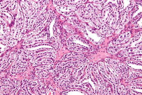 File:Clear cell papillary renal cell carcinoma - high mag.jpg