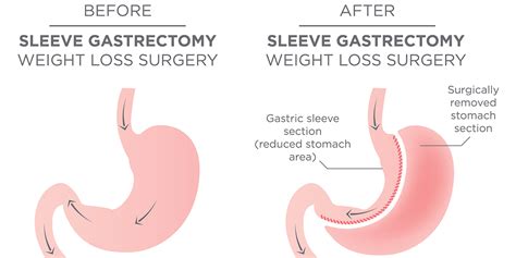 5 Things To Remember After Weight Loss Surgery Healthy Panacea