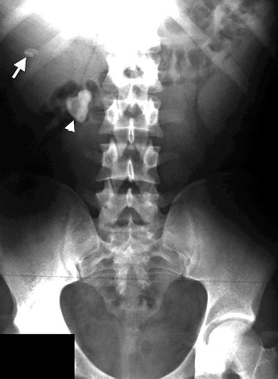 Kidney Stones Kub Xray