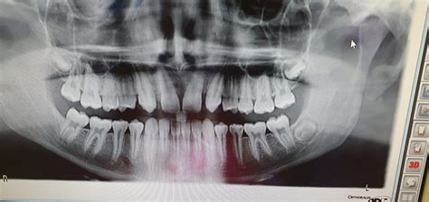 La Importancia De Realizar Radiograf As A Los A Os Centre Dental M