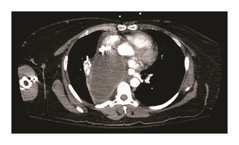 A The Patients Large Right Mediastinal Bronchogenic Cyst Displacing