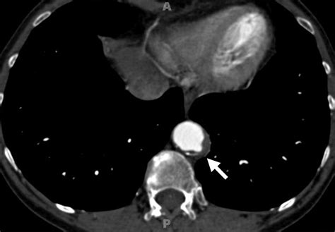 Abdominal Aortic Aneurysms Revisited MDCT With Multiplanar