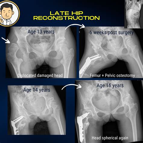 Cerebral palsy - Hip reconstruction