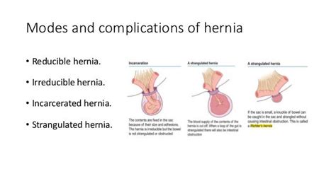 Inguinal And Femoral Hernia