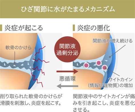 ひざに水がたまったらどうすればいい？原因と治療法を解説 ゴールドオンライン