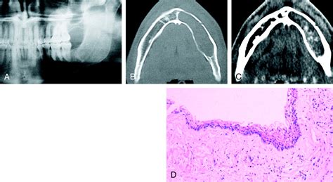 Unusual Ct Appearance In An Odontogenic Keratocyst Of The Mandible