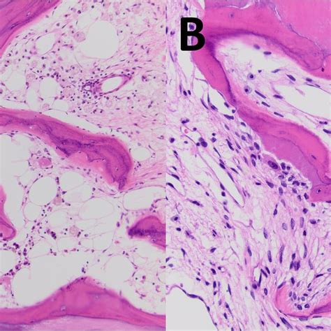 aortic valves  osseous metaplasia variably   fatty