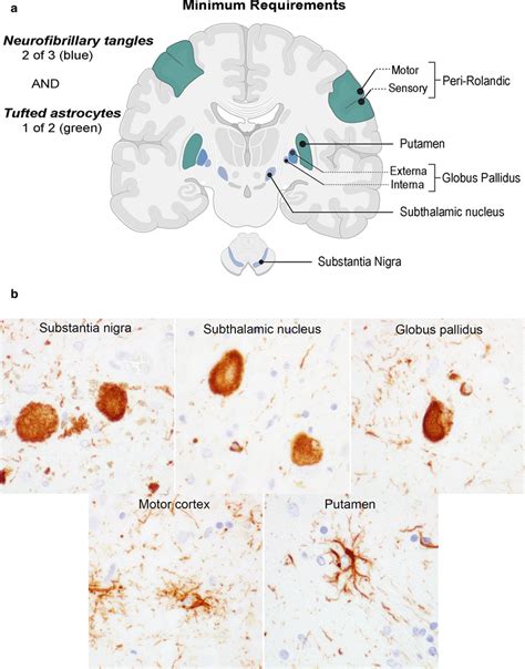 A Schematic Representation Of Tau Lesions Included In The Rainwater