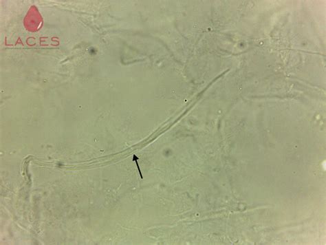 PATOLOGIA CLÍNICA SAÚDE URINA TURVA MUCO NA URINA O que pode ser