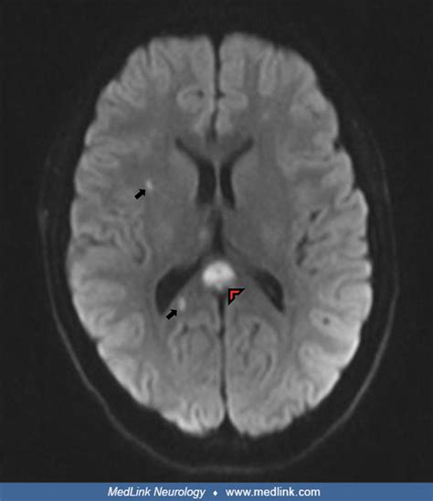 Susac Syndrome Medlink Neurology