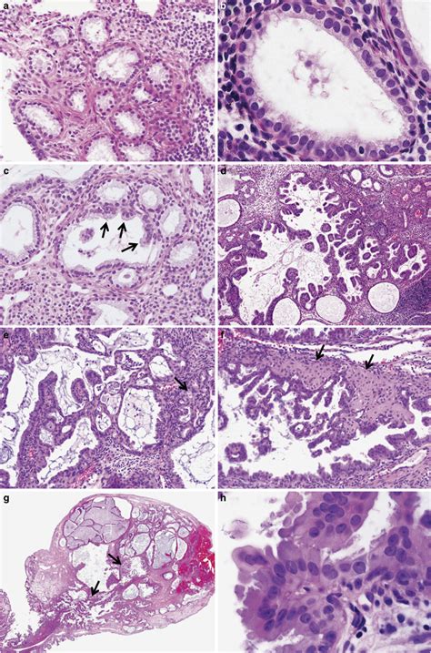 Papillary Mucinous Metaplasia Of The Endometrium As A Possible Precursor Of Endometrial Mucinous