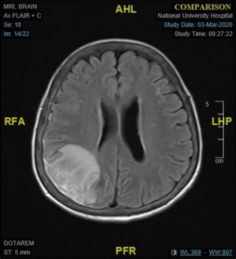 Contrast Enhanced Mri Brain Demonstrating Pachymeningeal Enhancement