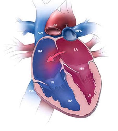 Patho Cardio Pediatric Flashcards Quizlet