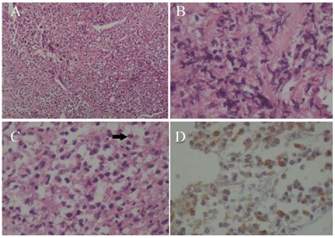 Figure From Malignant Intrasellar Meningioma Presenting As An