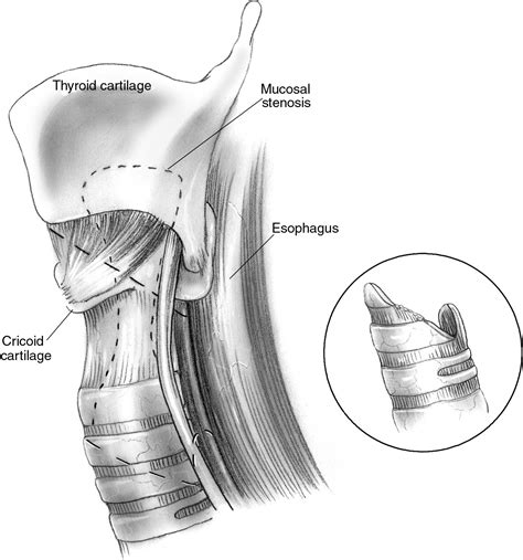 Surgical Management Of Subglottic Stenosis Operative Techniques In