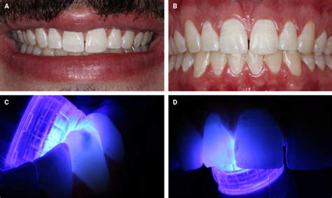 A Initial Smile Front View B Patient Presented With White Enamel