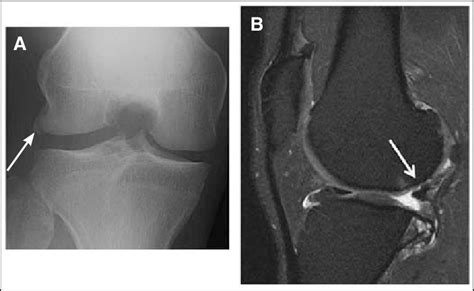 A Ap Radiograph Of The Knee Shows Mild Osteophytes But No Joint Space Download Scientific