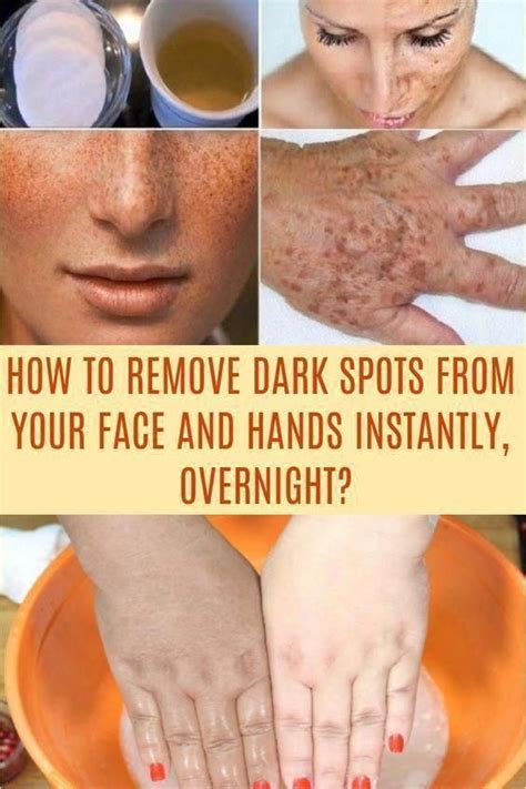 How To Get Rid Of Brown Spots On Experience SmallBrownSpotsOnFace