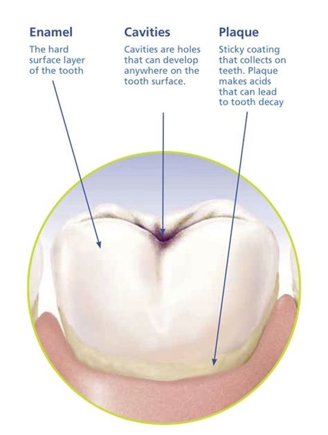 Dentaltown Enamel Is The Hard Surface Layer Of The Tooth Cavities