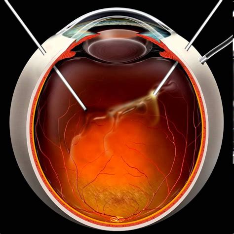 Pars Plana Vitrectomy Defined