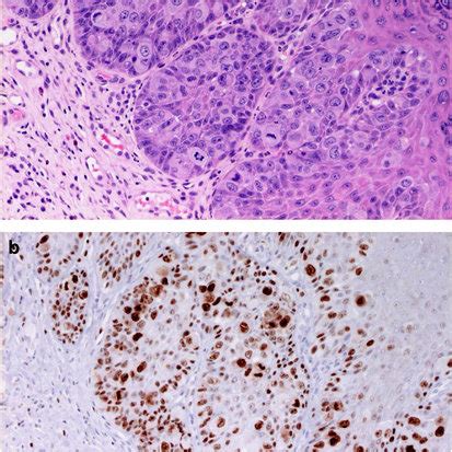 Anal Pagets Disease Showing Positive Proex T C Staining A