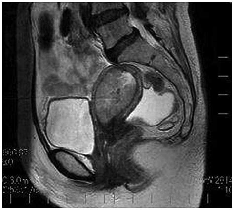 Endometrioid Adenocarcinoma Concurrent With A Blue Nevus Of The