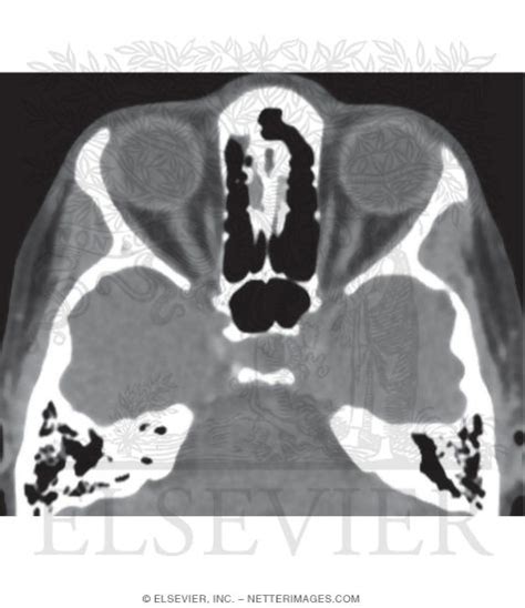 Axial Ct Through The Ethmoid And Splenoid Sinuses And Orbits