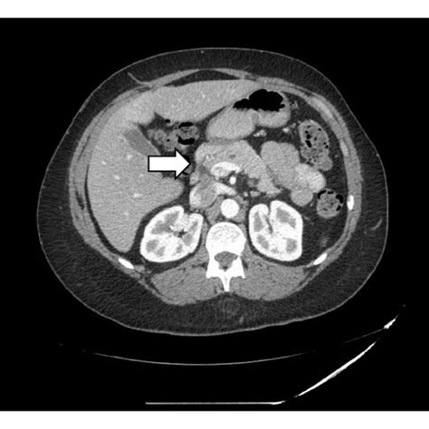 Eus Showing Hypoechoic Mass In The Pancreatic Uncinate Process During Download Scientific