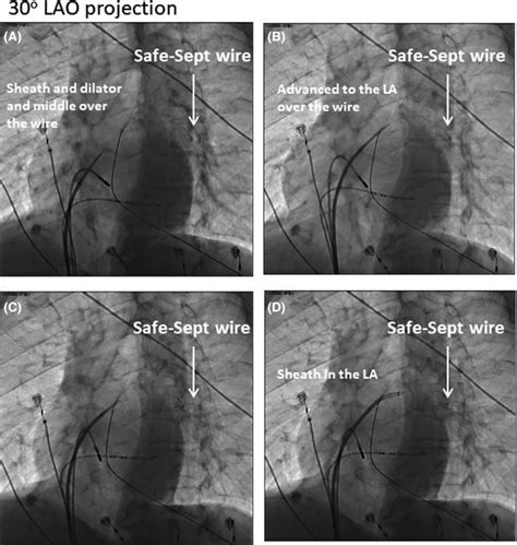 Transseptal Puncture Tsp Using Safesept Wire A Safesept Wire In