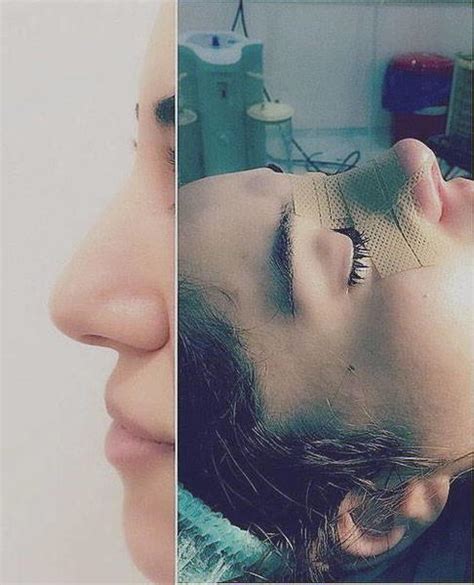 Aquiline Nose Photos (1) » Rhinoplasty: Cost, Pics, Reviews, Q&A