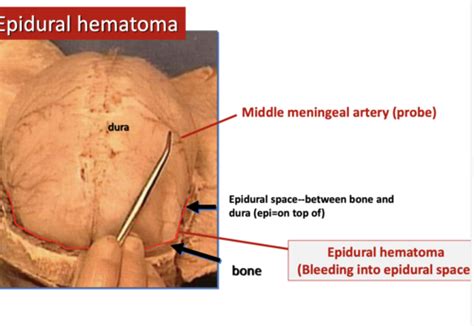 Epidural Hematoma Middle Meningeal Artery