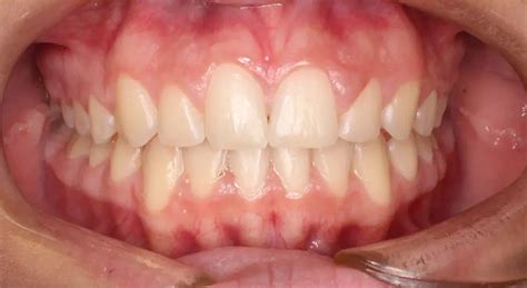 Before And After Invisalign Dillon Orthodontic Care