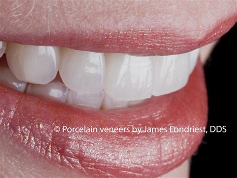 Porcelain Veneers Types And Uses Of A Porcelain Veneer