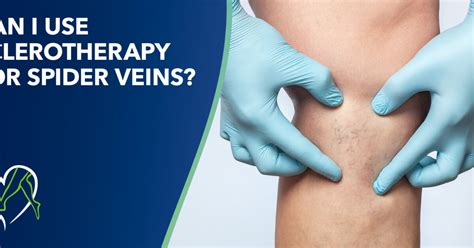 Can I Use Sclerotherapy For Spider Veins