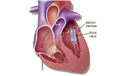 Bmv Balloon Mitral Valvuloplasty