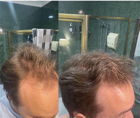 7 Month Update 1mg Finasteride And 2 5mg Minoxidil Tablets Daily R Tressless