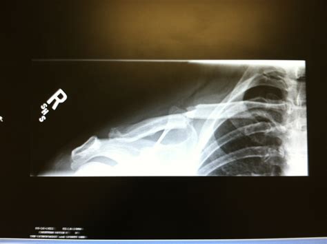 Broken Collarbone Blog