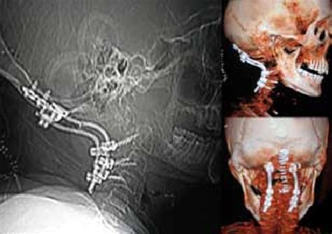 Post-operative ct scan showing occipitocervical fixation using rods and ...