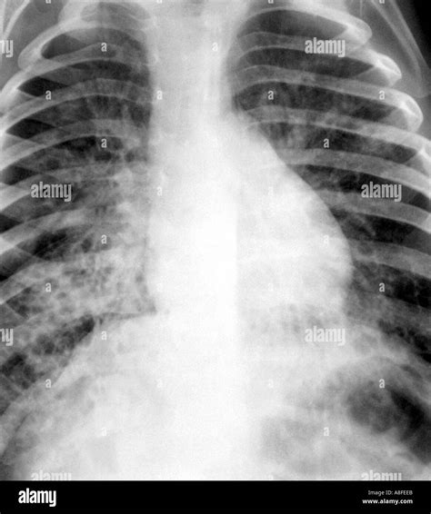 chest  ray cystic fibrosis stock photo alamy