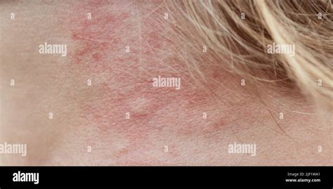 Bite Mark Sting Or Sore On Human Skin Close Up Of Symptoms