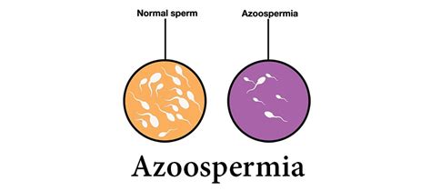 Azoospermia